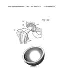 BIOACTIVE BONE GRAFT SUBSTITUTE diagram and image