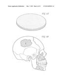 BIOACTIVE BONE GRAFT SUBSTITUTE diagram and image