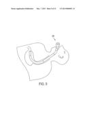 ENDOLUMINAL AND TRANSLUMINAL SURGICAL METHODS AND DEVICES diagram and image