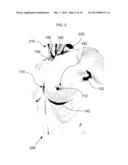 METHOD FOR DETERMINING BREAST VOLUME TO ASSIST MEDICAL PROCEDURE diagram and image