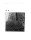 AUTOMATIC DETECTION OF CONTRAST INJECTION diagram and image