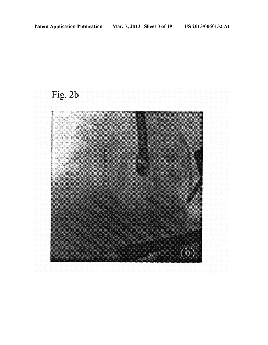 AUTOMATIC DETECTION OF CONTRAST INJECTION - diagram, schematic, and image 04