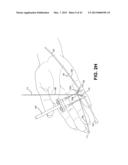 METHOD AND APPARATUS FOR REPAIRING A TENDON OR LIGAMENT diagram and image