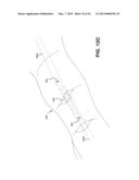 METHOD AND APPARATUS FOR REPAIRING A TENDON OR LIGAMENT diagram and image