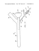 EXTRALUMINAL BALLOON DISSECTION diagram and image