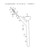 EXTRALUMINAL BALLOON DISSECTION diagram and image