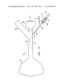 EXTRALUMINAL BALLOON DISSECTION diagram and image