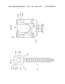 Bone Implants diagram and image