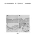 METHOD FOR DIAGNOSING MELANOCYTIC PROLIFERATIONS diagram and image