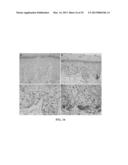 METHOD FOR DIAGNOSING MELANOCYTIC PROLIFERATIONS diagram and image