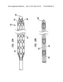 HEART ASSIST DEVICE WITH EXPANDABLE IMPELLER PUMP diagram and image