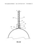 NORMALIZATION AND STABILIZATION OF BALLOON SURFACES FOR DEFLATION diagram and image