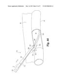 VASCULAR SUTURING DEVICE diagram and image