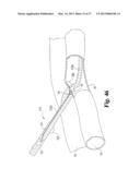 VASCULAR SUTURING DEVICE diagram and image