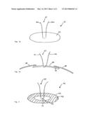 DEVICE FOR USE IN EYE SURGERY diagram and image