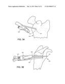 BONE GRAFT PLACEMENT DEVICE diagram and image