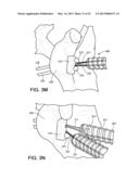 BONE GRAFT PLACEMENT DEVICE diagram and image