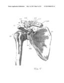 Clavicle Fixation diagram and image