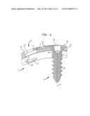 BONE SCREW RETAINING SYSTEM diagram and image