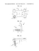 BONE SCREW RETAINING SYSTEM diagram and image