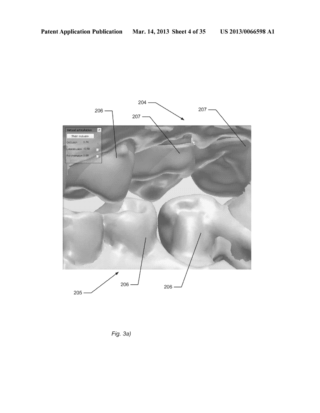 DYNAMIC VIRTUAL ARTICULATOR - diagram, schematic, and image 05