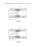 SYSTEMS AND METHODS FOR TREATING OBESITY AND OTHER GASTROINTESTINAL     CONDITIONS diagram and image