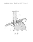 SYSTEMS AND METHODS FOR TREATING OBESITY AND OTHER GASTROINTESTINAL     CONDITIONS diagram and image