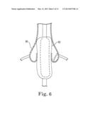 IMAGE-GUIDED HEART VALVE PLACEMENT OR REPAIR diagram and image