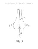 IMAGE-GUIDED HEART VALVE PLACEMENT OR REPAIR diagram and image