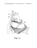 IMAGE-GUIDED HEART VALVE PLACEMENT OR REPAIR diagram and image