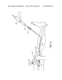 ENHANCED ULTRASOUND VISUALIZATION OF INTRAVASCULAR DEVICES diagram and image