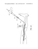 ENHANCED ULTRASOUND VISUALIZATION OF INTRAVASCULAR DEVICES diagram and image