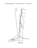 ENHANCED ULTRASOUND VISUALIZATION OF INTRAVASCULAR DEVICES diagram and image