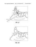 SINUS BALLOON DILATION CATHETERS AND SINUS SURGURY TOOLS diagram and image