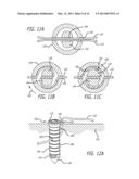 KNOTLESS SUTURE ANCHOR FOR SOFT TISSUE REPAIR AND METHOD OF USE diagram and image