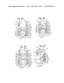 Connecting member with tensioned cord, low profile rigid sleeve and spacer     with torsion control diagram and image