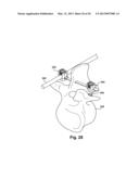 TETHER CLAMP AND IMPLANTATION SYSTEM diagram and image