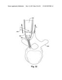 TETHER CLAMP AND IMPLANTATION SYSTEM diagram and image