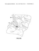 FENESTRATED BONE SCREWS AND METHODS OF BONE FASTENING AND STABILIZATION diagram and image