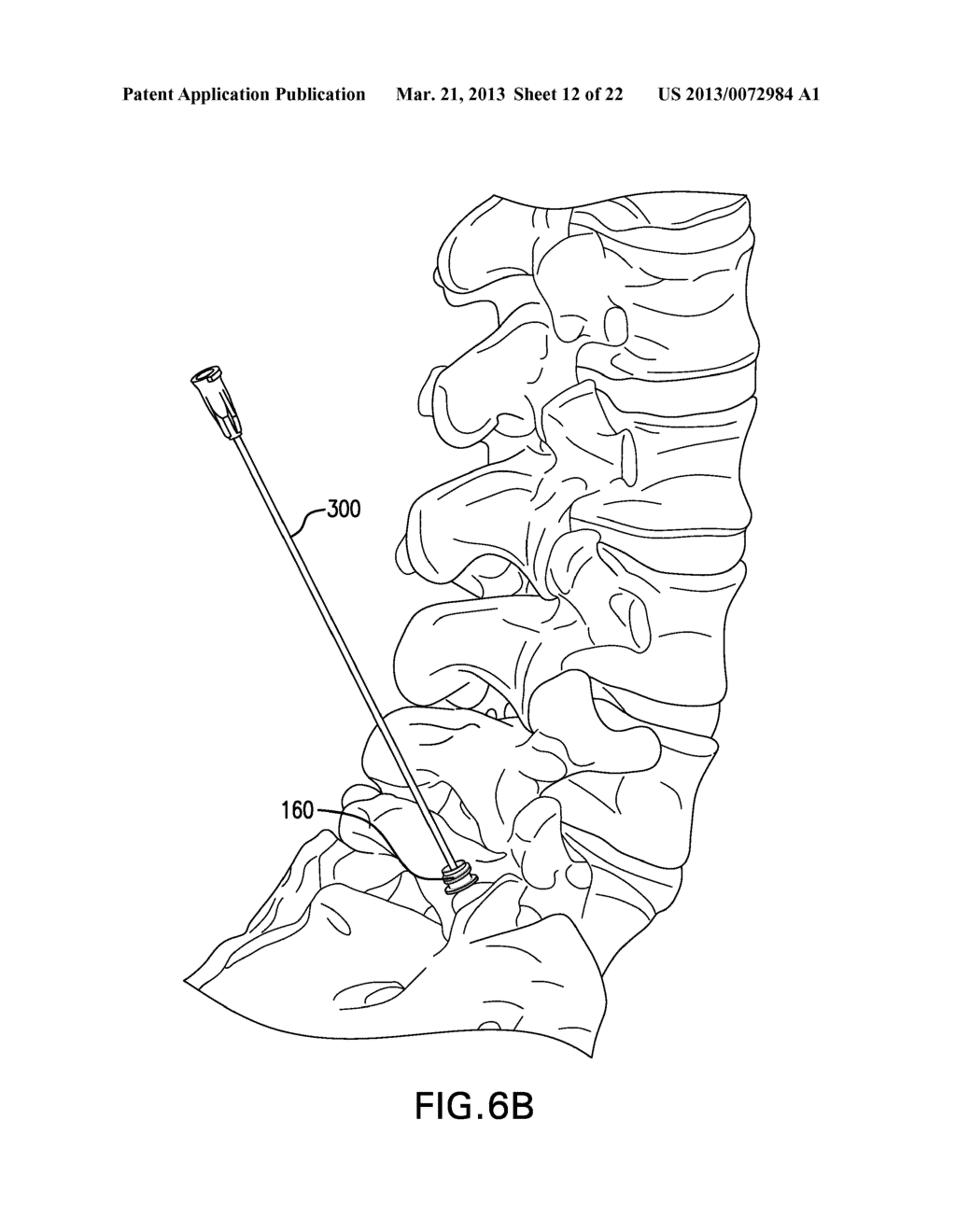 FENESTRATED BONE SCREWS AND METHODS OF BONE FASTENING AND STABILIZATION - diagram, schematic, and image 13