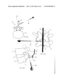 SYSTEMS AND METHODS FOR POSTERIOR DYNAMIC STABILIZATION OF THE SPINE diagram and image