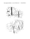 SYSTEMS AND METHODS FOR POSTERIOR DYNAMIC STABILIZATION OF THE SPINE diagram and image