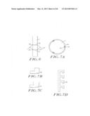 Cardiac Valve Procedure Methods and Devices diagram and image