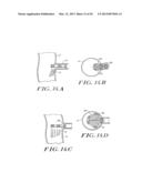 Cardiac Valve Procedure Methods and Devices diagram and image