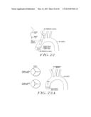 Cardiac Valve Procedure Methods and Devices diagram and image