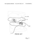 ANTI-OBSTRUCTIVE AIRWAY DENTAL ORTHOTIC diagram and image