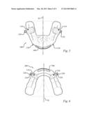 ANTI-OBSTRUCTIVE AIRWAY DENTAL ORTHOTIC diagram and image