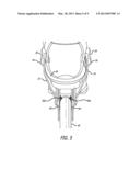 SKATE BRAKING SYSTEM diagram and image