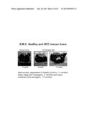 SERUM AND TISSUE BIOMARKERS OF HUMAN HCC diagram and image