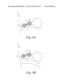 Expandable Implant System diagram and image